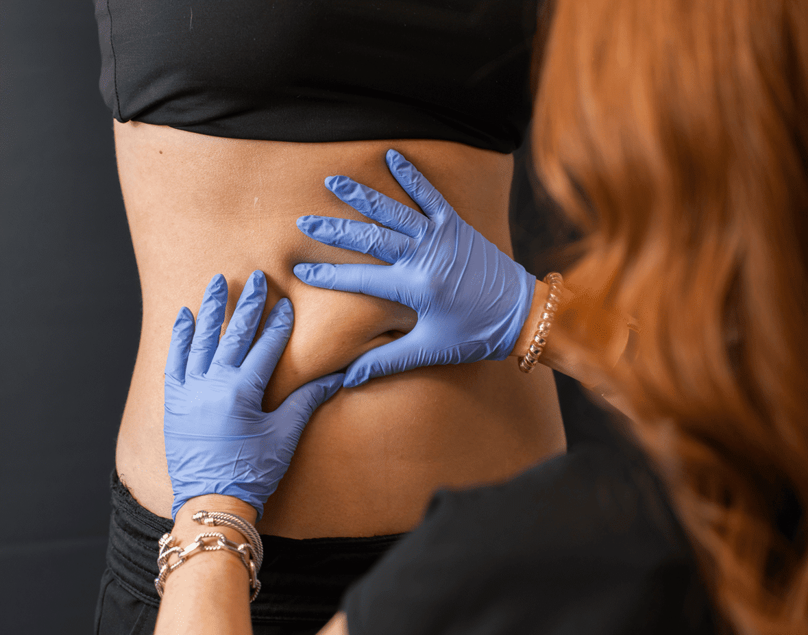 CoolSculpting at Southeast Sculpting + Rejuvenation in Fort Mill, SC