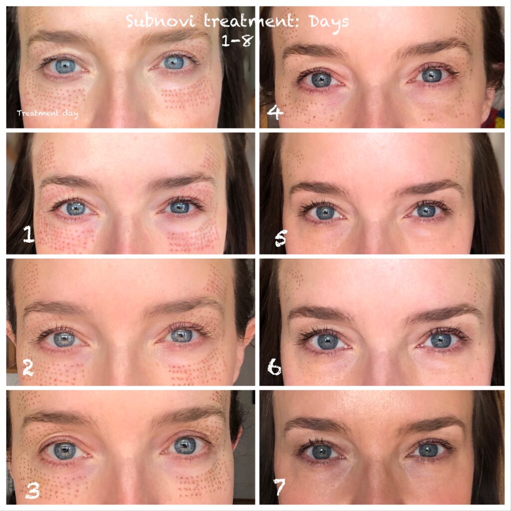 Subnovii Plasma Pen treatment in Fort Mill, SC