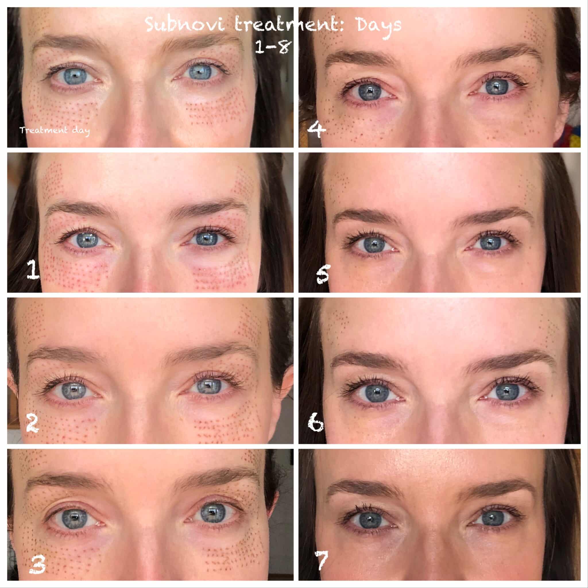 Subnovii Plasma Pen treatment in Fort Mill, SC